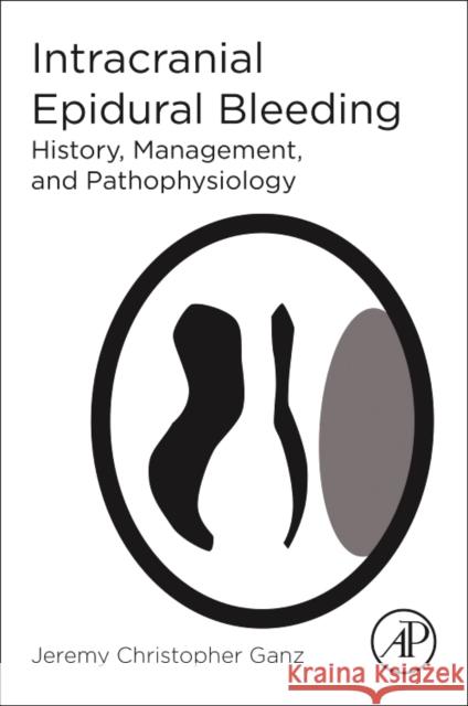 Intracranial Epidural Bleeding History, Management, and Pathophysiology