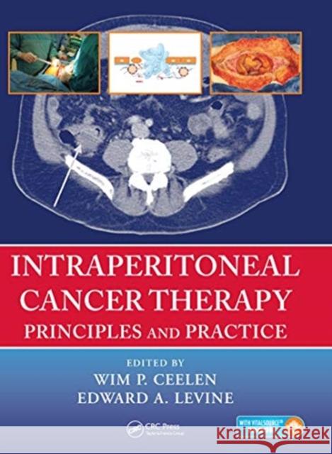 Intraperitoneal Cancer Therapy: Principles and Practice
