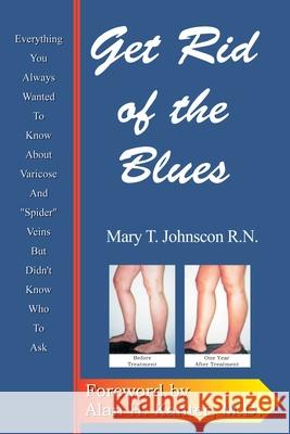 Get Rid of the Blues: Everything You Always Wanted to Know about Varicose and 