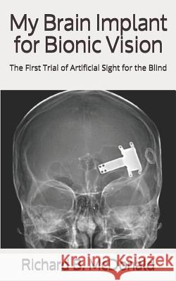 My Brain Implant for Bionic Vision: The First Trial of Artificial Sight for the Blind