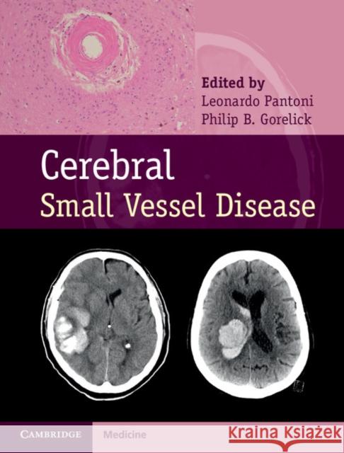 Cerebral Small Vessel Disease