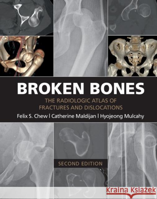 Broken Bones: The Radiologic Atlas of Fractures and Dislocations