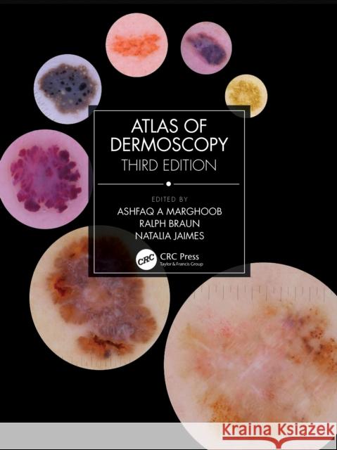 Atlas of Dermoscopy: Third Edition