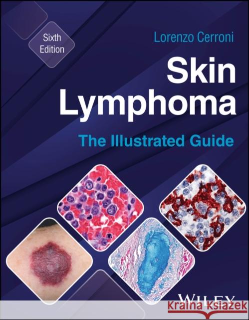 Skin Lymphoma