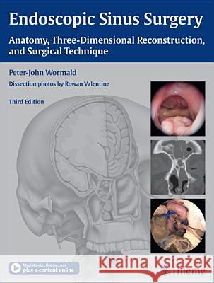 Endoscopic Sinus Surgery : Anatomy, Three-Dimensional Reconstruction, and Surgical Technique. Plus e-content online