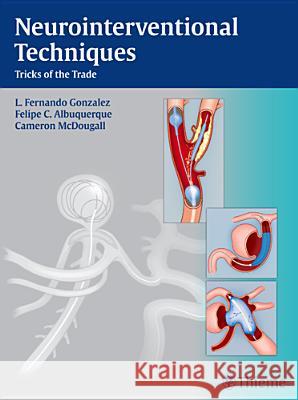 Neurointerventional Techniques : Tricks of the Trade