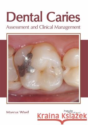 Dental Caries: Assessment and Clinical Management