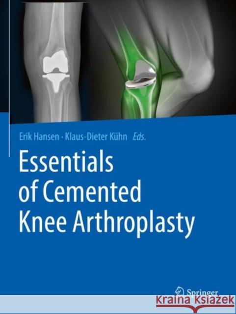 Essentials of Cemented Knee Arthroplasty