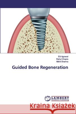 Guided Bone Regeneration