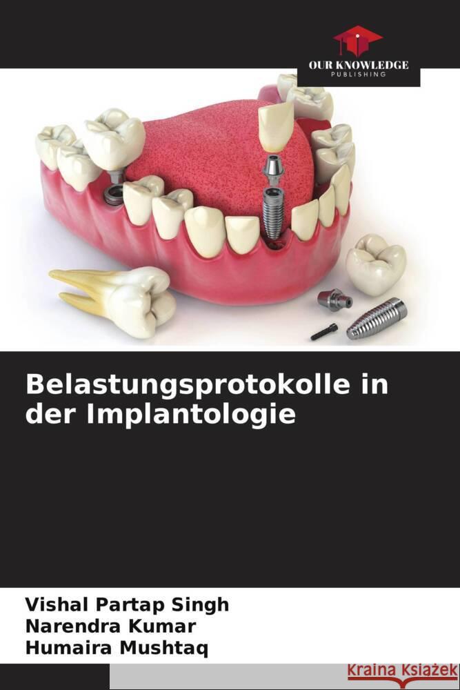 Belastungsprotokolle in der Implantologie