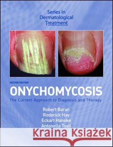 Onychomycosis: The Current Approach to Diagnosis and Therapy Baran, Robert 9780415385794 Taylor & Francis Group - książka