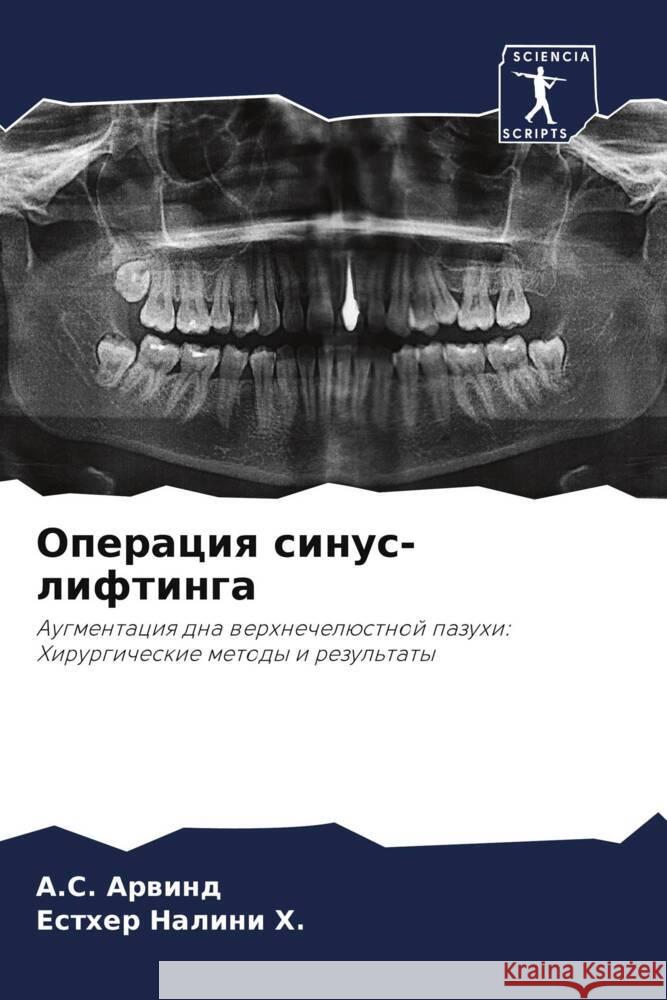 Operaciq sinus-liftinga Arwind, A.S., Nalini H., Esther 9786208268220 Sciencia Scripts - książka
