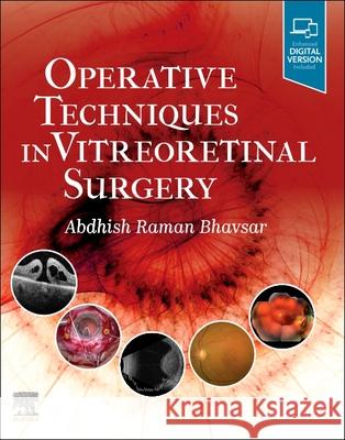 Operative Techniques in Vitreoretinal Surgery Abdhish Bhavsar 9780323709200 Elsevier - książka