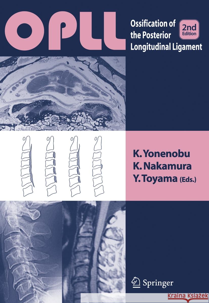 Opll: Ossification of the Posterior Longitudinal Ligament K. Yonenobu K. Nakamura Y. Toyama 9784431560463 Springer - książka