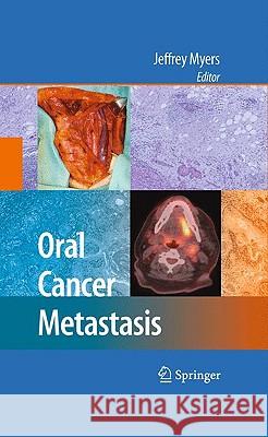 Oral Cancer Metastasis Jeffrey Myers 9781441907745 Springer - książka