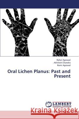 Oral Lichen Planus: Past and Present Agrawal Rahul, Chandra Akhilesh 9783659336027 LAP Lambert Academic Publishing - książka