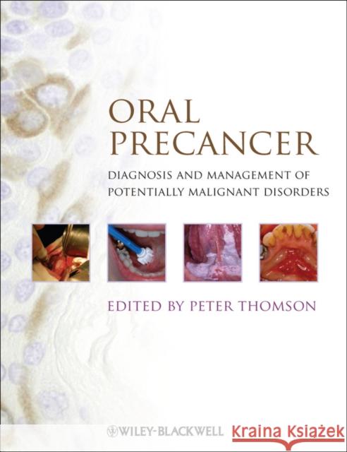 Oral Precancer: Diagnosis and Management of Potentially Malignant Disorders Thomson, Peter 9781444335743 Wiley-Blackwell - książka