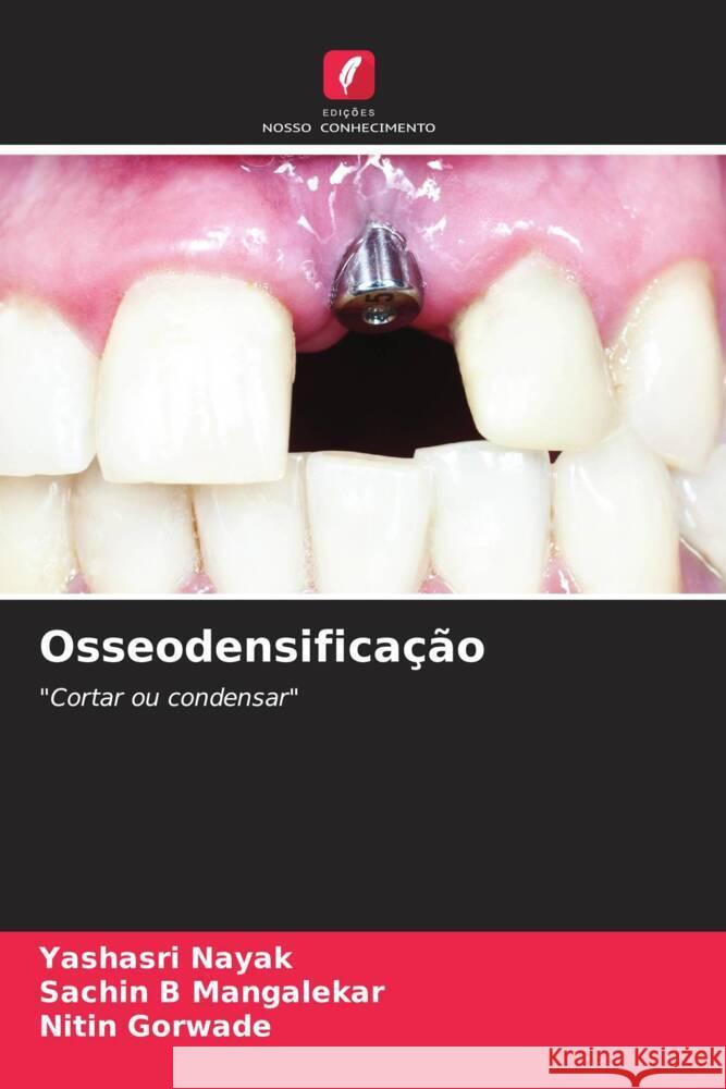 Osseodensifica??o Yashasri Nayak Sachin B. Mangalekar Nitin Gorwade 9786206892953 Edicoes Nosso Conhecimento - książka