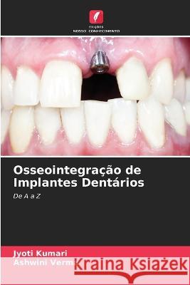 Osseointegra??o de Implantes Dent?rios Jyoti Kumari Ashwini Verma 9786205712511 Edicoes Nosso Conhecimento - książka