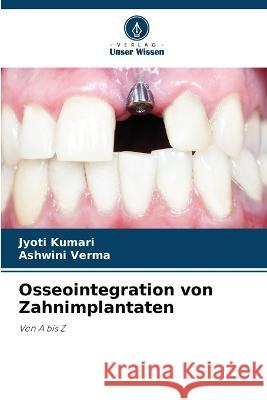 Osseointegration von Zahnimplantaten Jyoti Kumari Ashwini Verma 9786205712474 Verlag Unser Wissen - książka