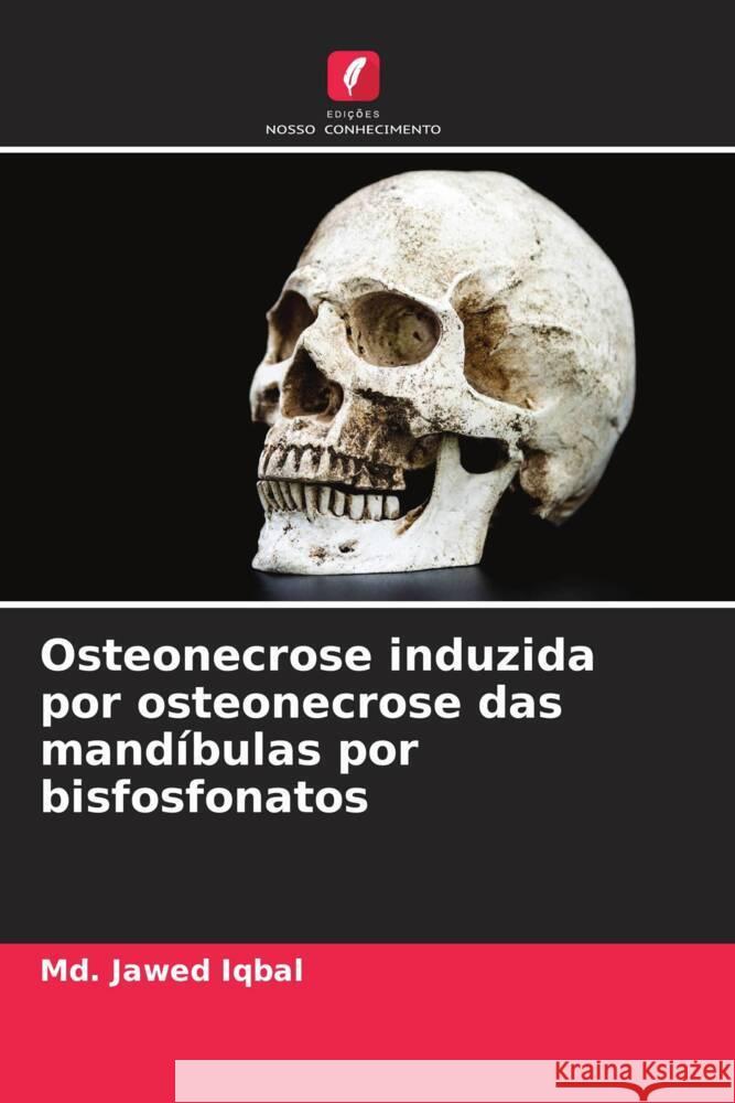 Osteonecrose induzida por osteonecrose das mandíbulas por bisfosfonatos Iqbal, Md. Jawed 9786204468587 Edições Nosso Conhecimento - książka