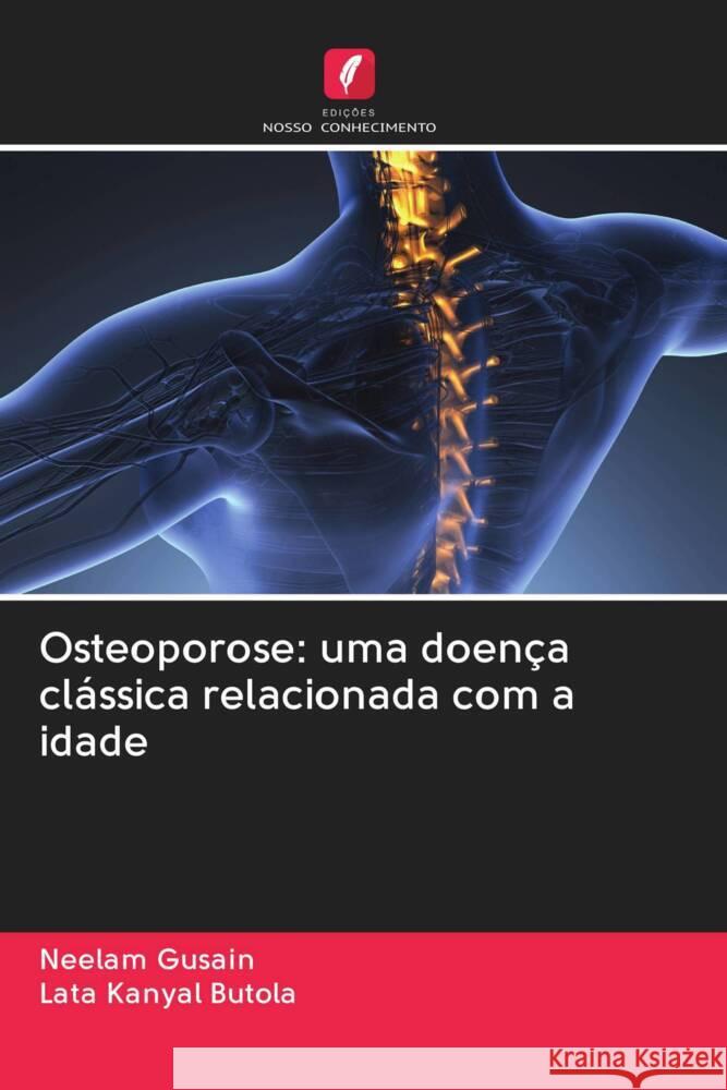 Osteoporose: uma doença clássica relacionada com a idade Gusain, Neelam, Kanyal Butola, Lata 9786203022469 Edicoes Nosso Conhecimento - książka