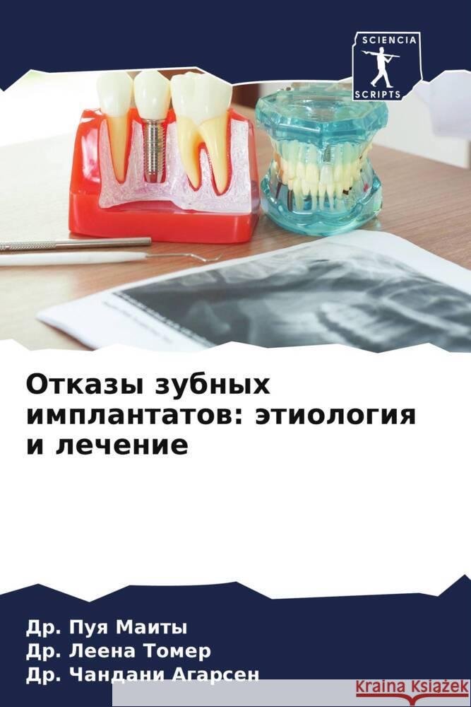 Otkazy zubnyh implantatow: ätiologiq i lechenie Maity, Dr. Puq, Tomer, Dr. Leena, Agarsen, Dr. Chandani 9786206369271 Sciencia Scripts - książka