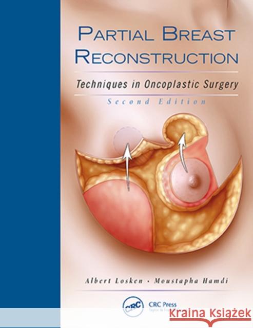 Partial Breast Reconstruction: Techniques in Oncoplastic Surgery Losken, Albert 9781626236912 Thieme Medical Publishers - książka