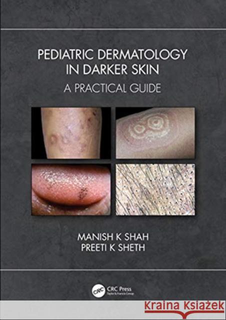 Pediatric Dermatology in Skin of Color: A Practical Guide Shah, Manish K. 9781138486102 CRC Press - książka