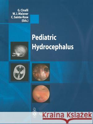 Pediatric Hydrocephalus G. Cinalli W. J. Maixner C. Sainte-Rose 9788847021730 Springer - książka