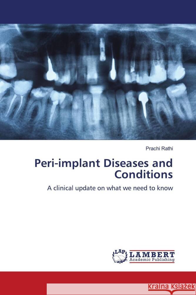 Peri-implant Diseases and Conditions Rathi, Prachi 9786207462674 LAP Lambert Academic Publishing - książka