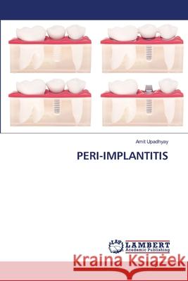 Peri-Implantitis Amit Upadhyay 9786202802123 LAP Lambert Academic Publishing - książka