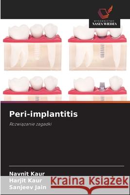 Peri-implantitis Kaur, Navnit, Kaur, Harjit, Jain, Sanjeev 9786209335457 Wydawnictwo Nasza Wiedza - książka