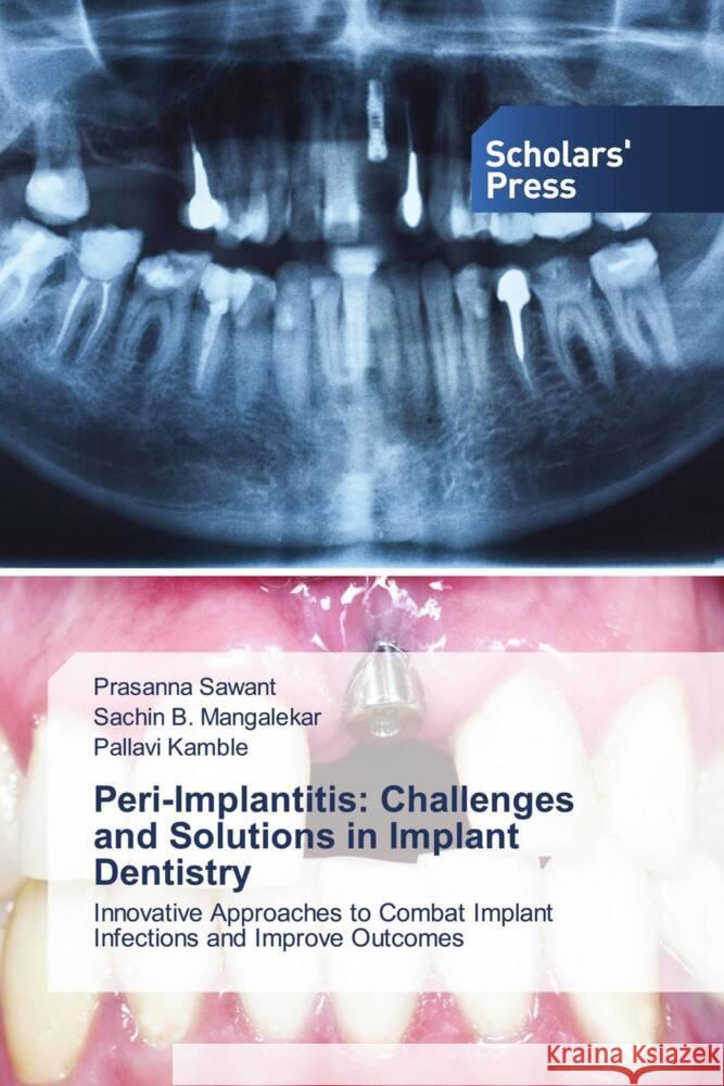 Peri-Implantitis: Challenges and Solutions in Implant Dentistry Sawant, Prasanna, Mangalekar, Sachin B., Kamble, Pallavi 9783639715040 Scholars' Press - książka