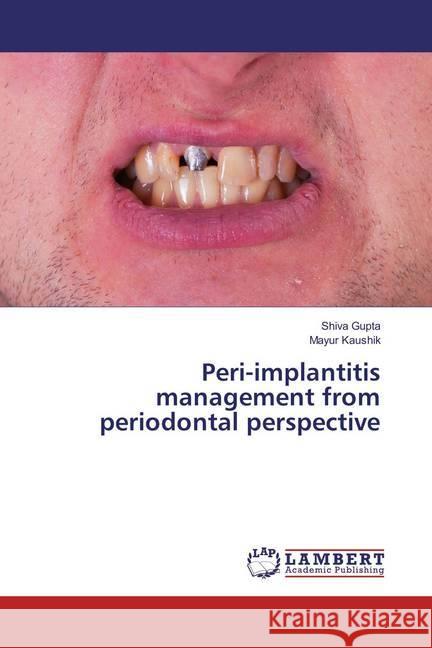 Peri-implantitis management from periodontal perspective Gupta, Shiva; Kaushik, Mayur 9783659890727 LAP Lambert Academic Publishing - książka