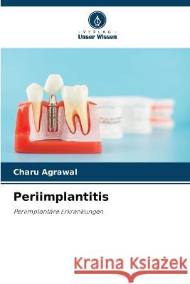 Periimplantitis Charu Agrawal   9786205629833 Verlag Unser Wissen - książka