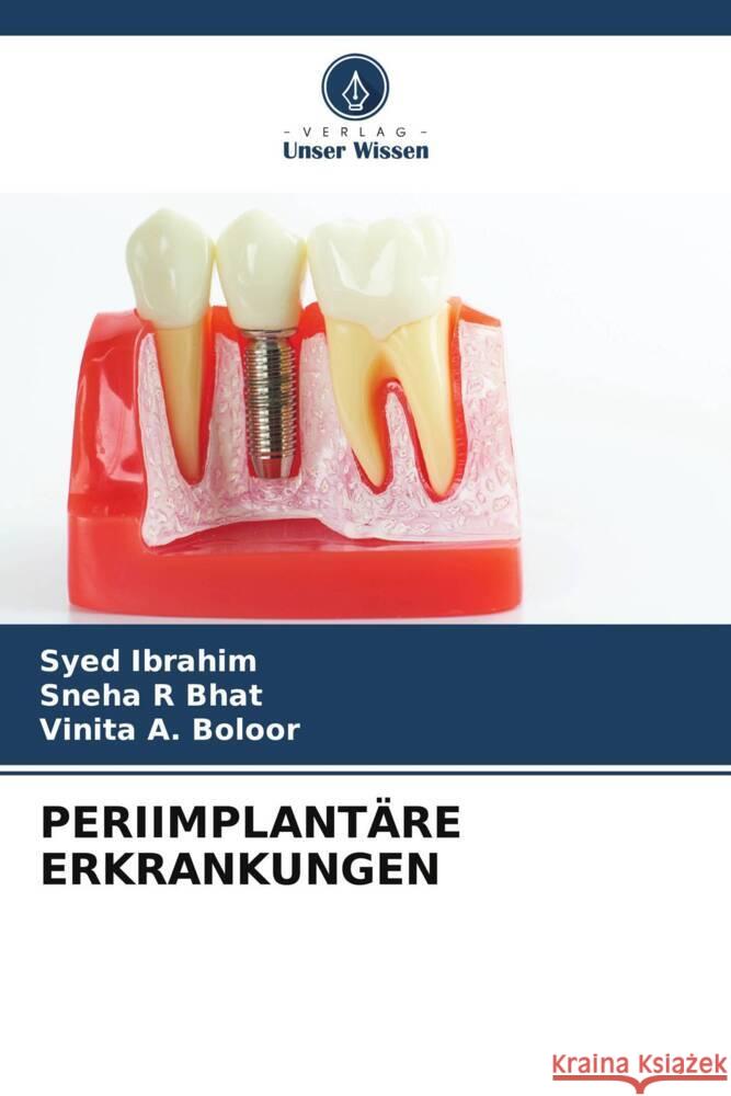 Periimplant?re Erkrankungen Syed Ibrahim Sneha R. Bhat Vinita A. Boloor 9786207339617 Verlag Unser Wissen - książka