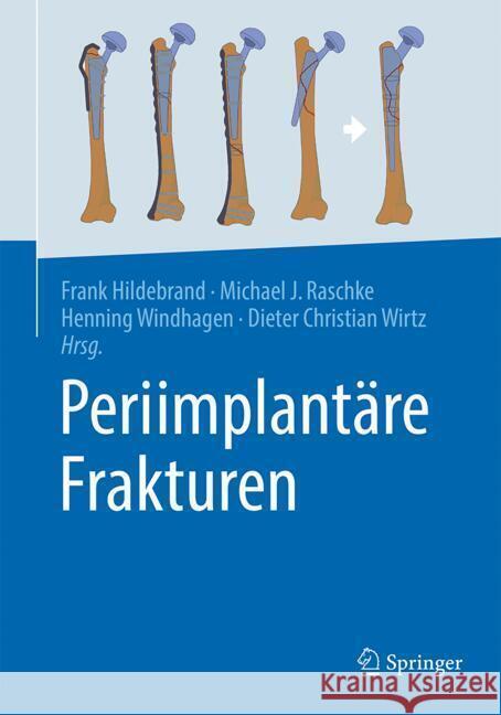 Periimplant?re Frakturen Frank Hildebrand Michael Raschke Henning Windhagen 9783662693124 Springer - książka
