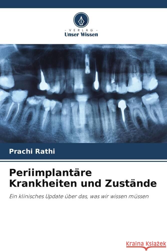 Periimplant?re Krankheiten und Zust?nde Prachi Rathi 9786207497621 Verlag Unser Wissen - książka