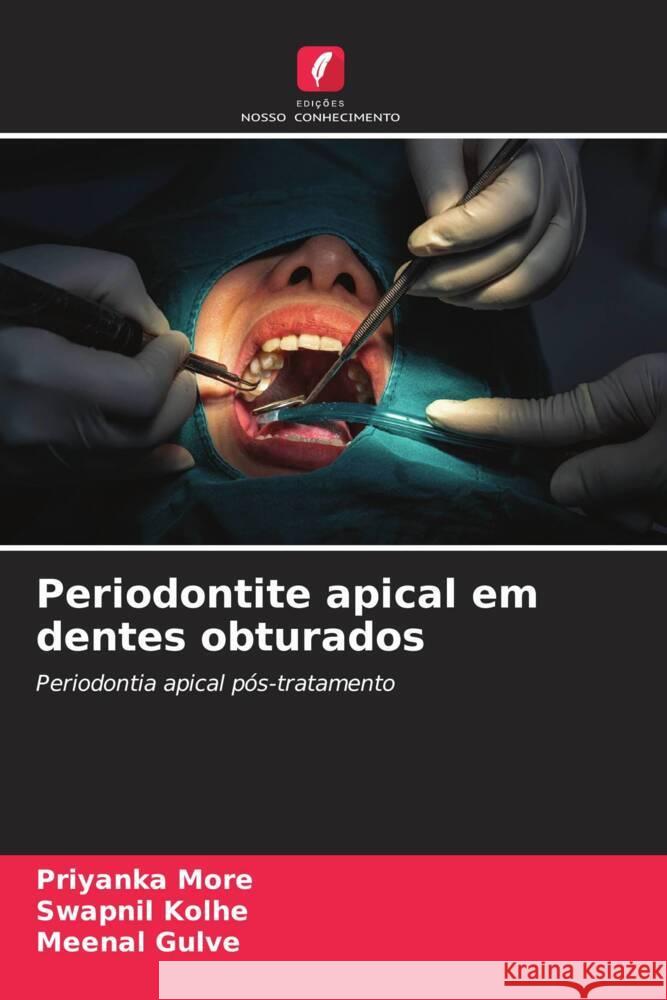 Periodontite apical em dentes obturados Priyanka More Swapnil Kolhe Meenal Gulve 9786208047122 Edicoes Nosso Conhecimento - książka