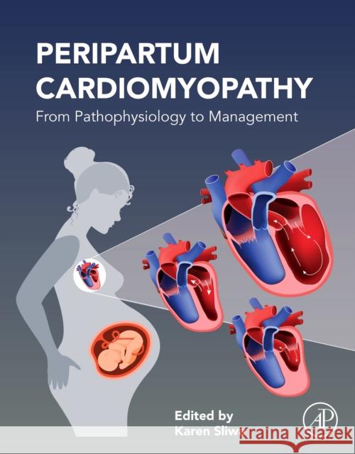Peripartum Cardiomyopathy: From Pathophysiology to Management Karen Sliwa 9780128176672 Academic Press - książka