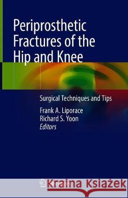 Periprosthetic Fractures of the Hip and Knee: Surgical Techniques and Tips Liporace, Frank A. 9783319430072 Springer - książka