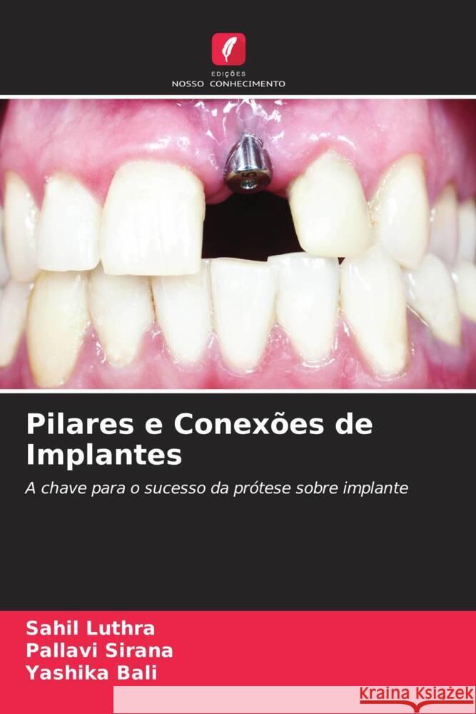 Pilares e Conexões de Implantes Luthra, Sahil, Sirana, Pallavi, Bali, Yashika 9786204629100 Edições Nosso Conhecimento - książka