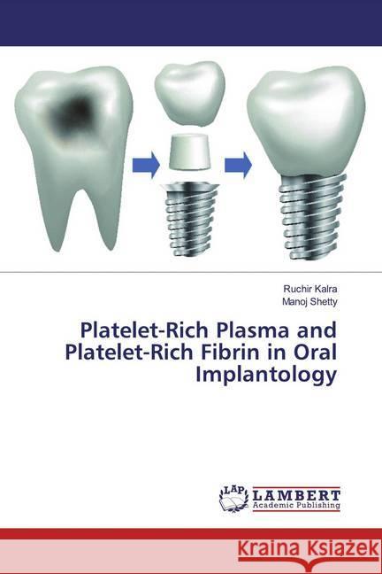 Platelet-Rich Plasma and Platelet-Rich Fibrin in Oral Implantology Kalra, Ruchir; Shetty, Manoj 9786202079112 LAP Lambert Academic Publishing - książka