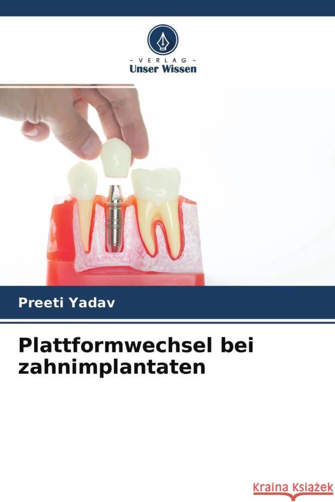 Plattformwechsel bei zahnimplantaten Yadav, Preeti 9786204344027 Verlag Unser Wissen - książka