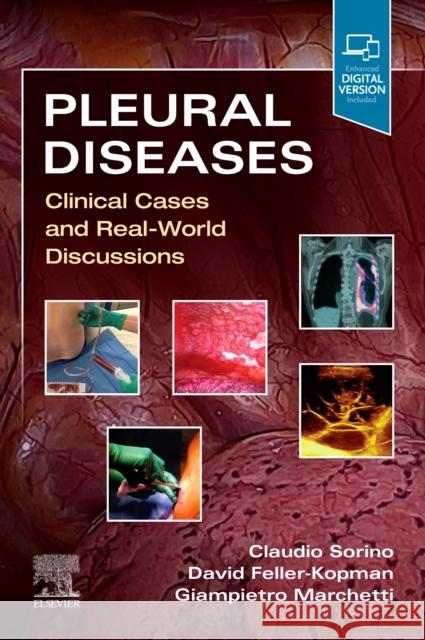 Pleural Diseases: Clinical Cases and Real-World Discussions Claudio Sorino David Feller-Kopman Giampietro Marchetti 9780323795418 Elsevier - książka