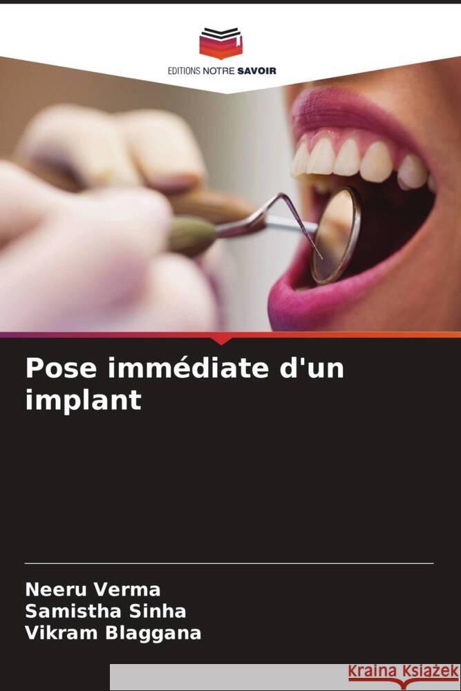 Pose imm?diate d'un implant Neeru Verma Samistha Sinha Vikram Blaggana 9786206546573 Editions Notre Savoir - książka