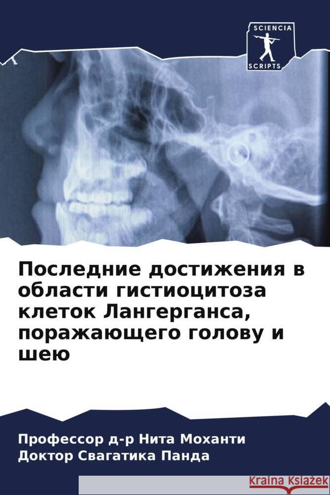 Poslednie dostizheniq w oblasti gistiocitoza kletok Langergansa, porazhaüschego golowu i sheü Mohanti, Professor d-r Nita, Panda, Doktor Swagatika 9786208326982 Sciencia Scripts - książka