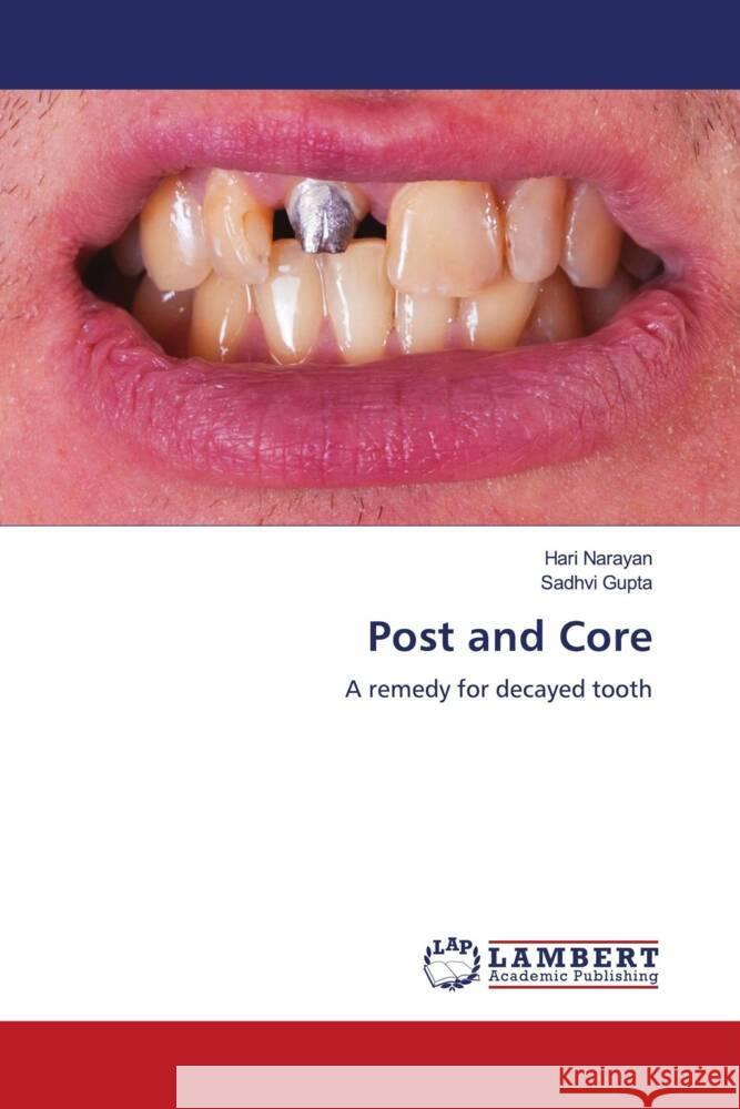Post and Core Narayan, Hari, Gupta, Sadhvi 9786206779650 LAP Lambert Academic Publishing - książka