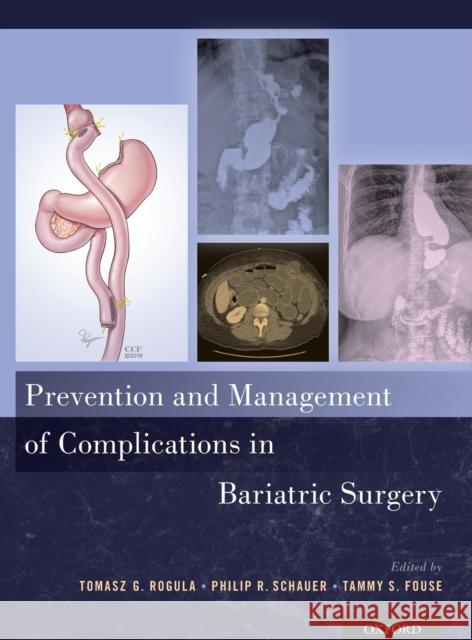 Prevention and Management of Complications in Bariatric Surgery Tomasz G. Rogula Philip Schauer Tammy Fouse 9780190608347 Oxford University Press, USA - książka